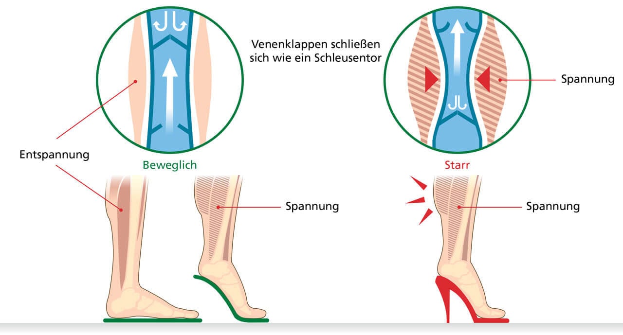 Diagram showing the effects of flexible vs. stiff leg muscles and vein valves Illustration comparing the effects of flexible leg muscles and vein valves on the left with tension in stiff muscles on the right, including high heel use.
