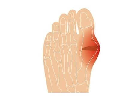 Illustration eines Hallux Valgus am linken Fuß Anatomische Darstellung eines Hallux Valgus, einer Fehlstellung des großen Zehs mit roter Markierung auf der Außenseite des linken Fußes