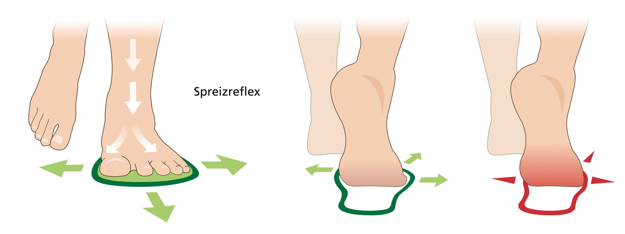 Grafik des Spreizreflexes des Fußes in verschiedenen Ansichten Illustration von Füßen mit Pfeilen zur Darstellung des Spreizreflexes des Fußes aus verschiedenen Perspektiven.
