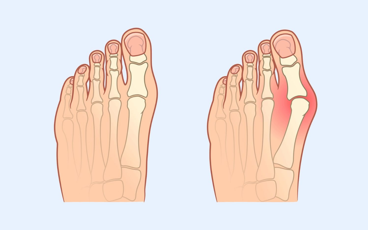 Vergleich eines gesunden Fußes mit einem Hallux valgus Illustration von zwei Füßen mit Knochenansicht: links ein gesunder Fuß, rechts ein Fuß mit Hallux valgus-Deformität.