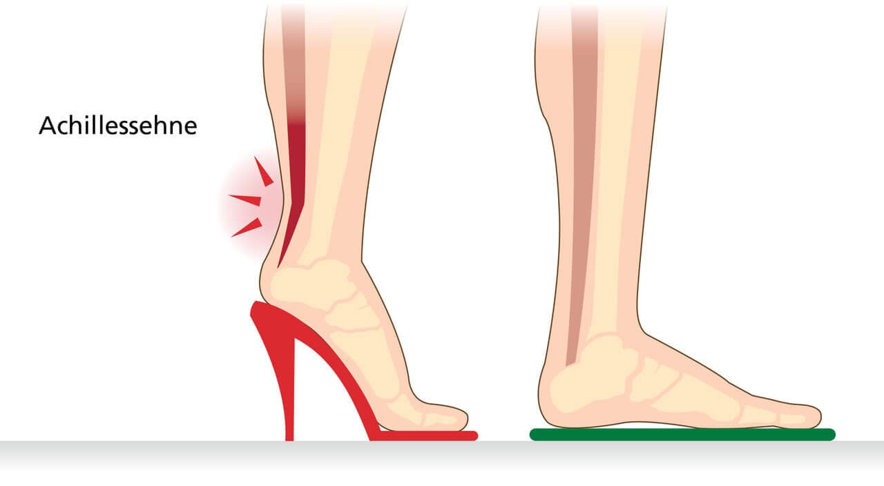Illustration der Achillessehne unter Spannung in hohen Absätzen und flachen Schuhen Grafische Darstellung der Achillessehne, die Belastung und Druck durch das Tragen von hohen Absätzen und flachen Schuhen zeigt.