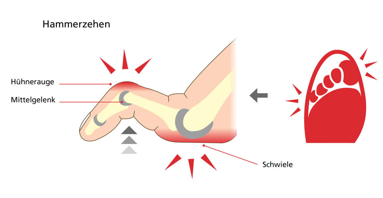 Illustration of Hammer Toe with Corns and Calluses Diagram showing hammer toe with labeled corns and a callus on the middle joint, highlighting pain points.