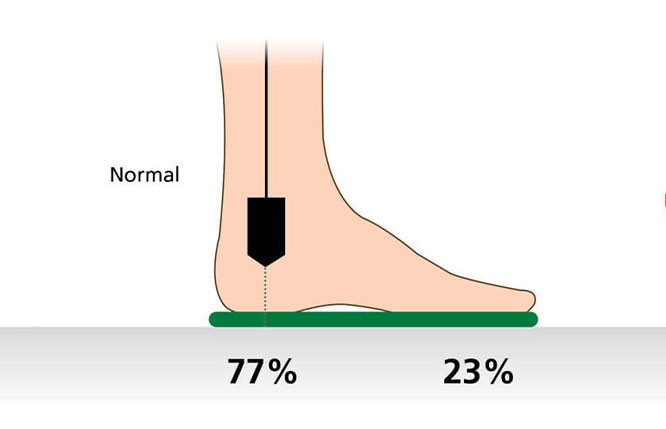 Diagramm zur Druckverteilung des Fußes im Stehen Illustration eines Fußes mit Druckverteilung von 77% auf der Ferse und 23% auf dem Vorfuß, beschriftet mit 'Normal'