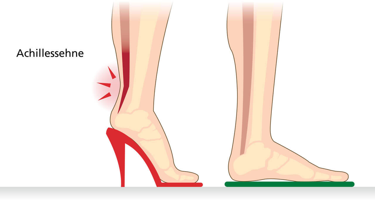 Illustration der Achillessehne unter Spannung in hohen Absätzen und flachen Schuhen Grafische Darstellung der Achillessehne, die Belastung und Druck durch das Tragen von hohen Absätzen und flachen Schuhen zeigt.
